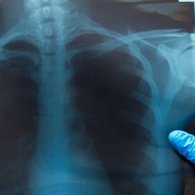 x-ray